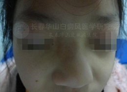 女童面部局限性白斑一年半
