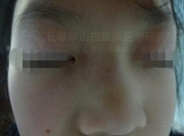 女童面部局限性白斑一年半