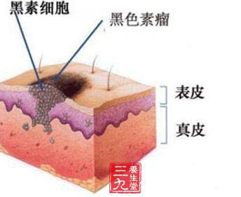 白癜风也有并发症？这5种并发症，白癜风患者你们过招了吗？